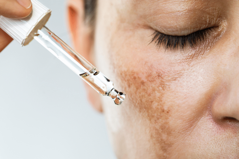 Hyperpigmentation treatment