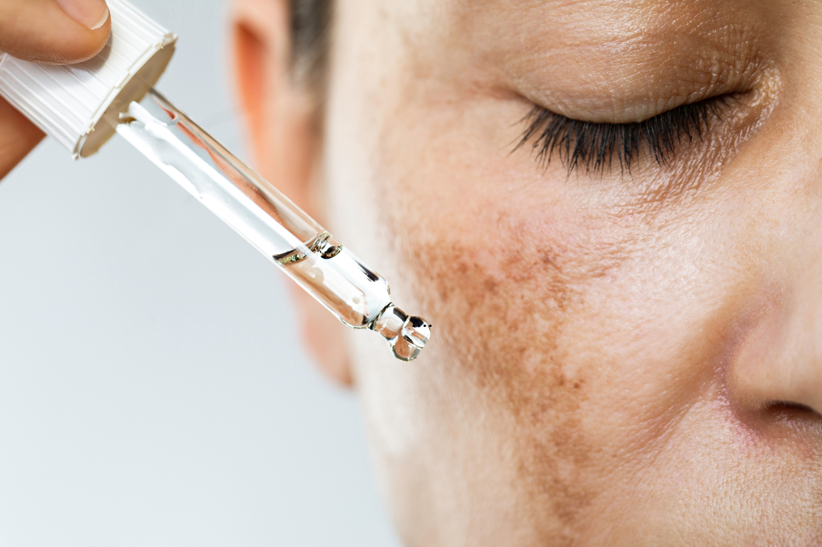 Hyperpigmentation treatment