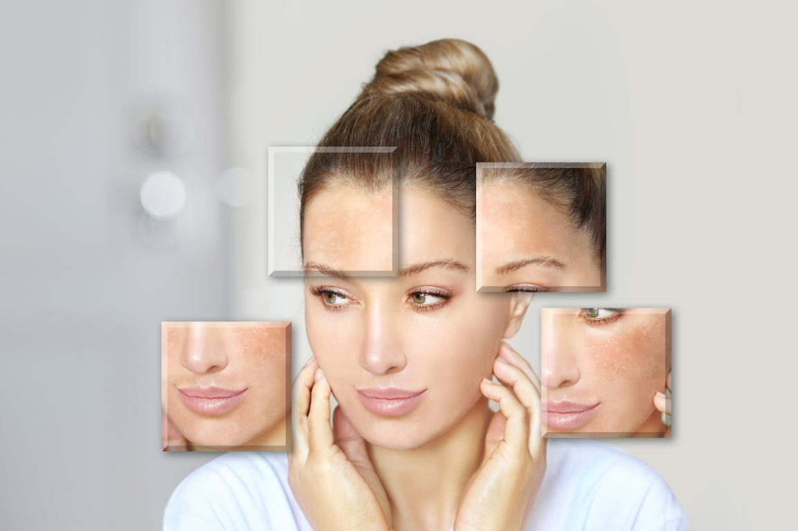Hyperpigmentation treatment
